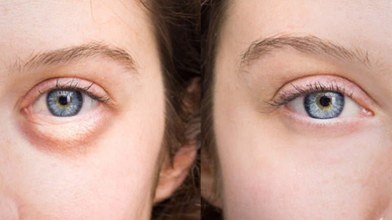 5 طرق مضمونة لعلاج انتفاخات العينين - لوك عربية 